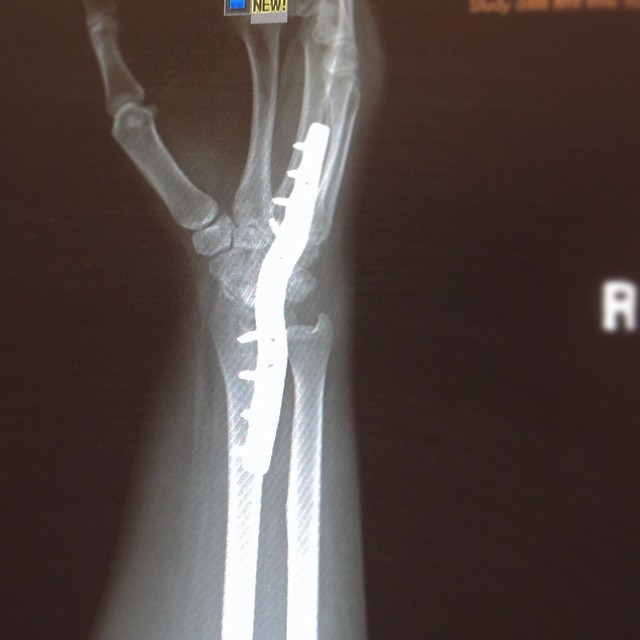 Avascular Osteonecrosis surgery